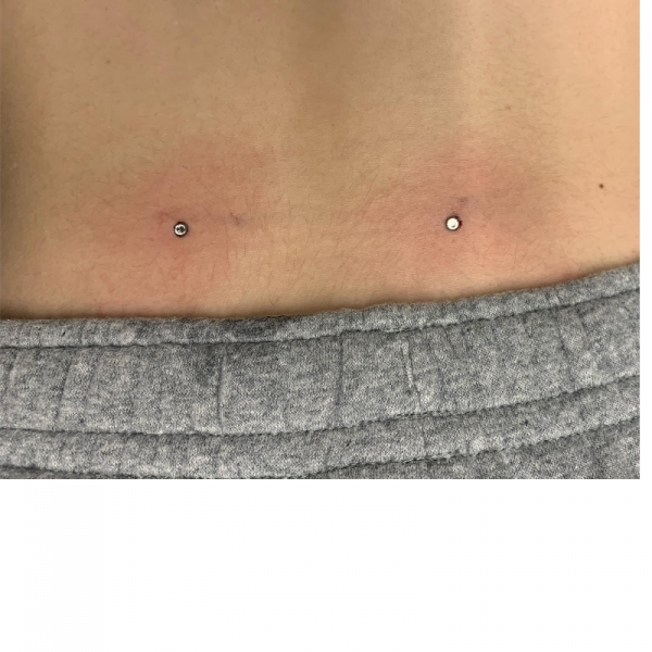 Dermal