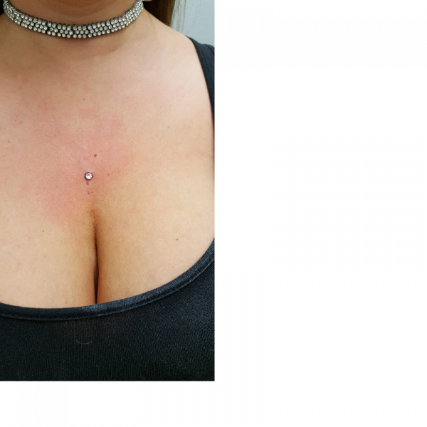 Chest Dermal